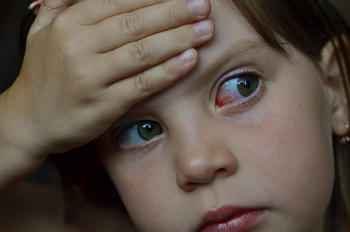 Coceira intensa nos olhos durante a primavera pode ser sinal da conjuntivite primaveril