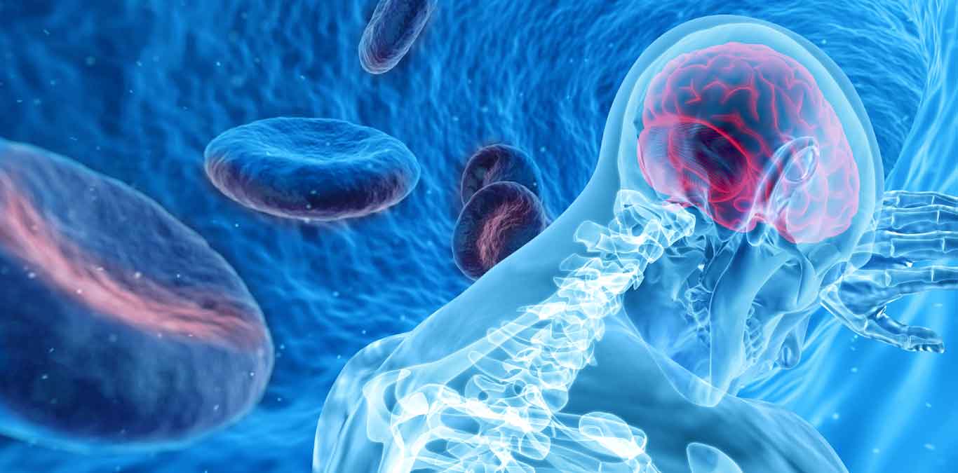 Neurologista alerta: tratamento do AVC deve come&ccedil;ar em at&eacute; 4 horas