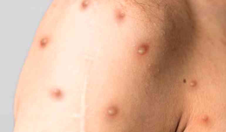 Nova cepa da mpox preocupa cientistas ap&oacute;s falha em testes e resultado de estudo com antiviral